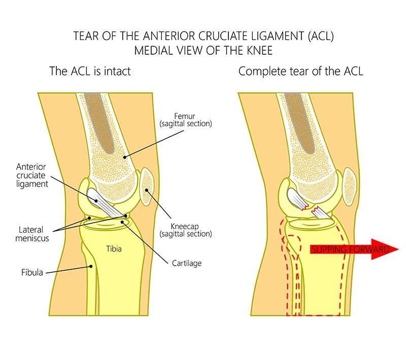 Anterior Cruciate Ligament Sprain Treatment in Tamilnadu