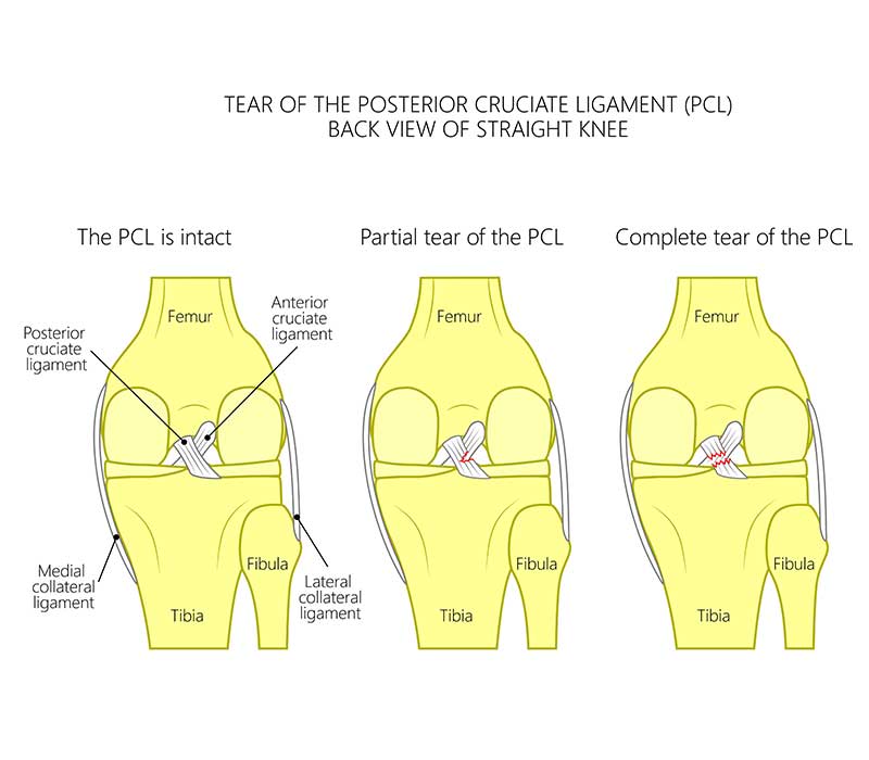 PCL Tear Treatment in Tamilnadu